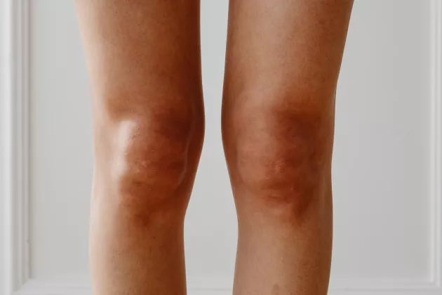 A photo of knees taken from the front