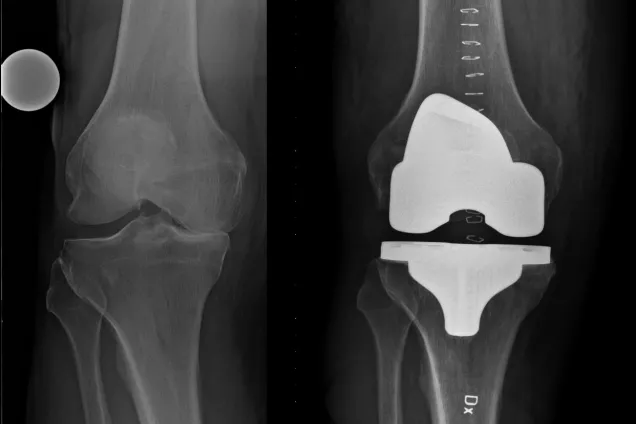 X-ray image of two knee joints. The x-ray image to the left shows a knee affected by osteoarthritis and the x-ray image to the right shows a knee with a prosthesis.